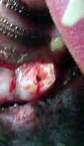 cat tooth fracture - example 1 - 110px x 177px